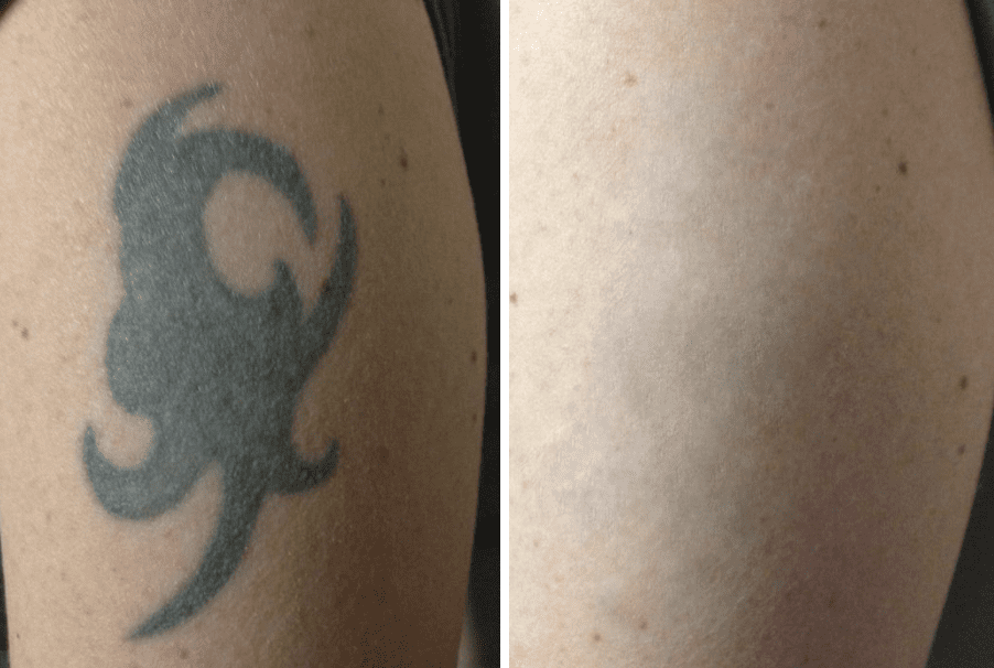 Tattoo Removal With the PicoSure® Laser The Spa at Spring Ridge